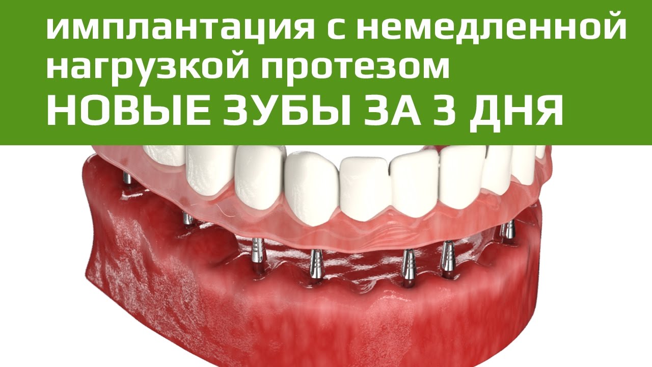 Имплантация зубов с немедленной нагрузкой протезом. Новые зубы за 3 дня.