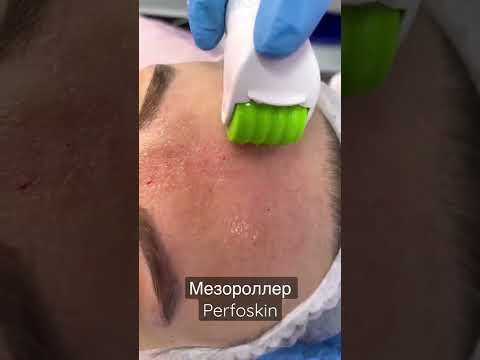 Мезороллер Perfoskin