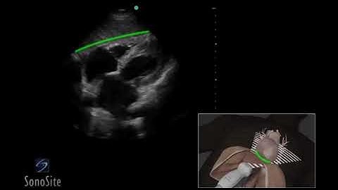 3D How To  Subxiphoid View, Echocardiography