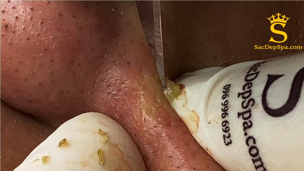 Treatment of Blackheads, Nodule | Điều Trị Mụn Đầu Đen, Mụn Bọc - SacDepSpa#111