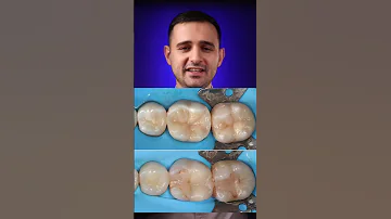 Как отличить хорошую пломбу от плохой?