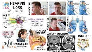 INSTANT NEURO - Hearing loss