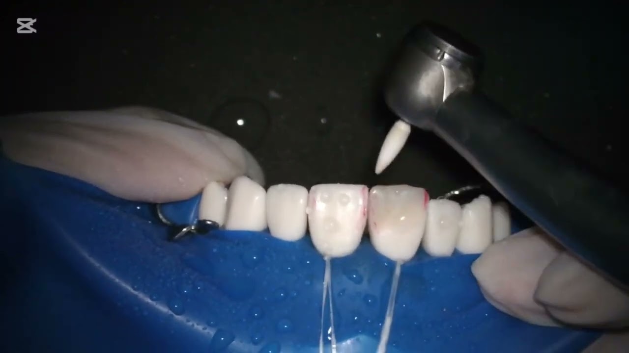 Class IV Composite Restoration Step by Step