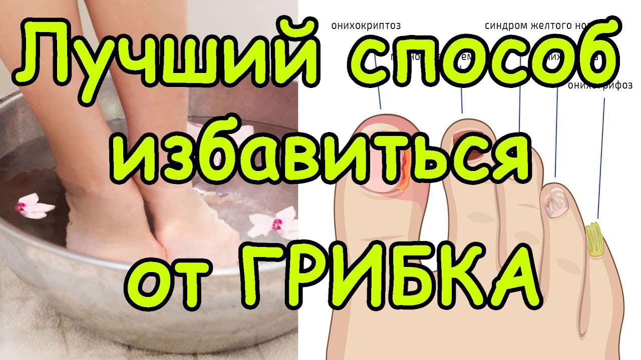 Как Избавиться от Грибка Раз и Навсегда Эффективный Способ Избавления от Грибка на ногах