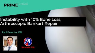 Instability with 10% Bone Loss, Arthroscopic Bankart Repair - Paul Favorito, MD