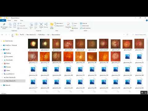 Glaucoma detection in fundus image using CNN