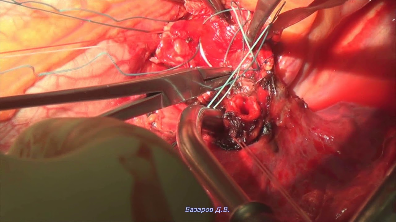 Step by step - Циркулярная резекция левого главного бронха (РНЦХ)