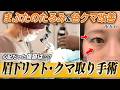 【28歳 眉下切開・クマ取り】目周り複合施術💡傷跡キレイで目元パッチリ👁️さらには頭痛も改善✨【眉下リフト+裏ハムラ】