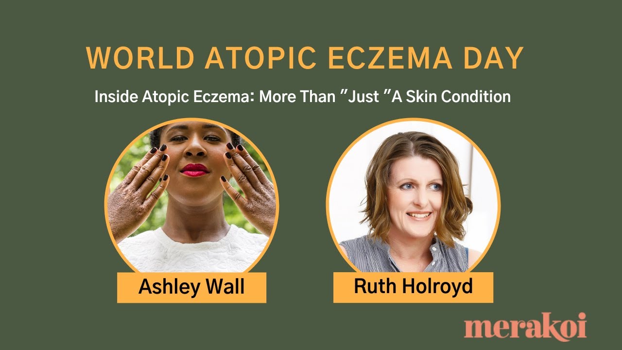 Talking About Eczema With Ashley Marie What Allergy Blog