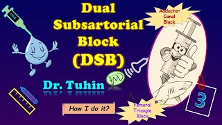 Dual Subsartorial Block | DSB| Adductor Canal Block | Femoral Triangle Block | Ultrasound