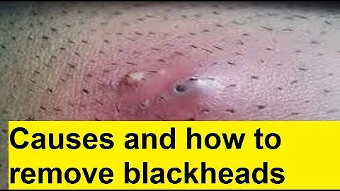 Causes and how to remove blackheads