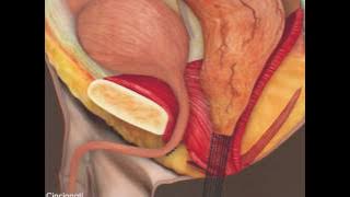 Surgical Treatment of Bulbar Urethral Fistula | Cincinnati Children's