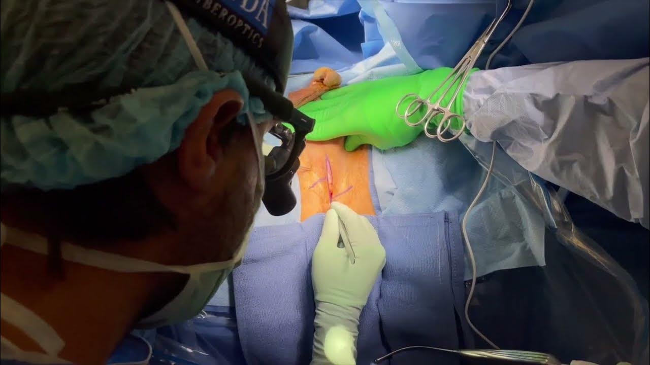 Core Videos 2021 Perineal Urethrostomy With Z Plasty Flap YouTube core-videos-2021-perineal-urethrostomy-with-z-plasty-flap-youtube
