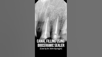 Canal Filling using bioceramic sealer #dentalbean