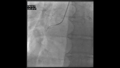 RCA – staged PCI 2