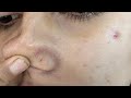 How to remove blackheads at home remedy naturally priya creations