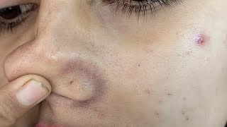 How To Remove Blackheads at Home Remedy Naturally| Priya Creations| screenshot 3
