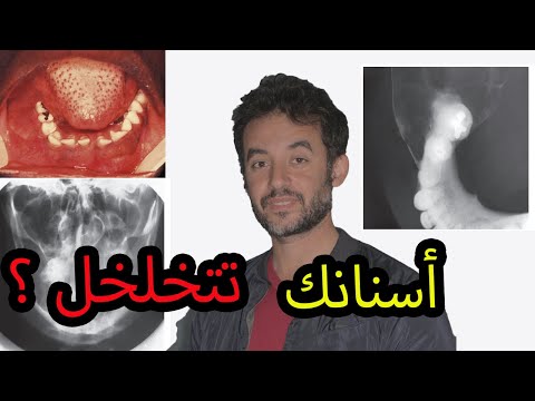 حالة خلخلة أسنان نادرة و إزاى عالجناها