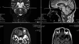 Semantic dementia