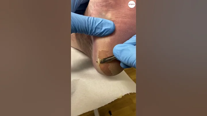 Podiatrist removal of callus from heels