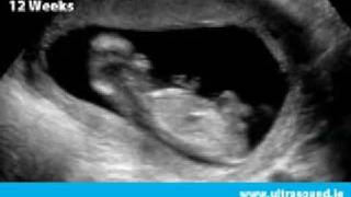 Early Pregnancy Scan In Dublin, Ireland Www.ultrasound.ie