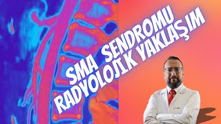 Sma Sendromunda Radyolojik Tanı Yaklaşımı