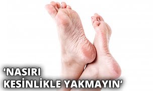 Uzmanından uyarı: Nasırı kesinlikle yakmayın