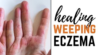 5 Natural Ways to Treat Weeping Eczema