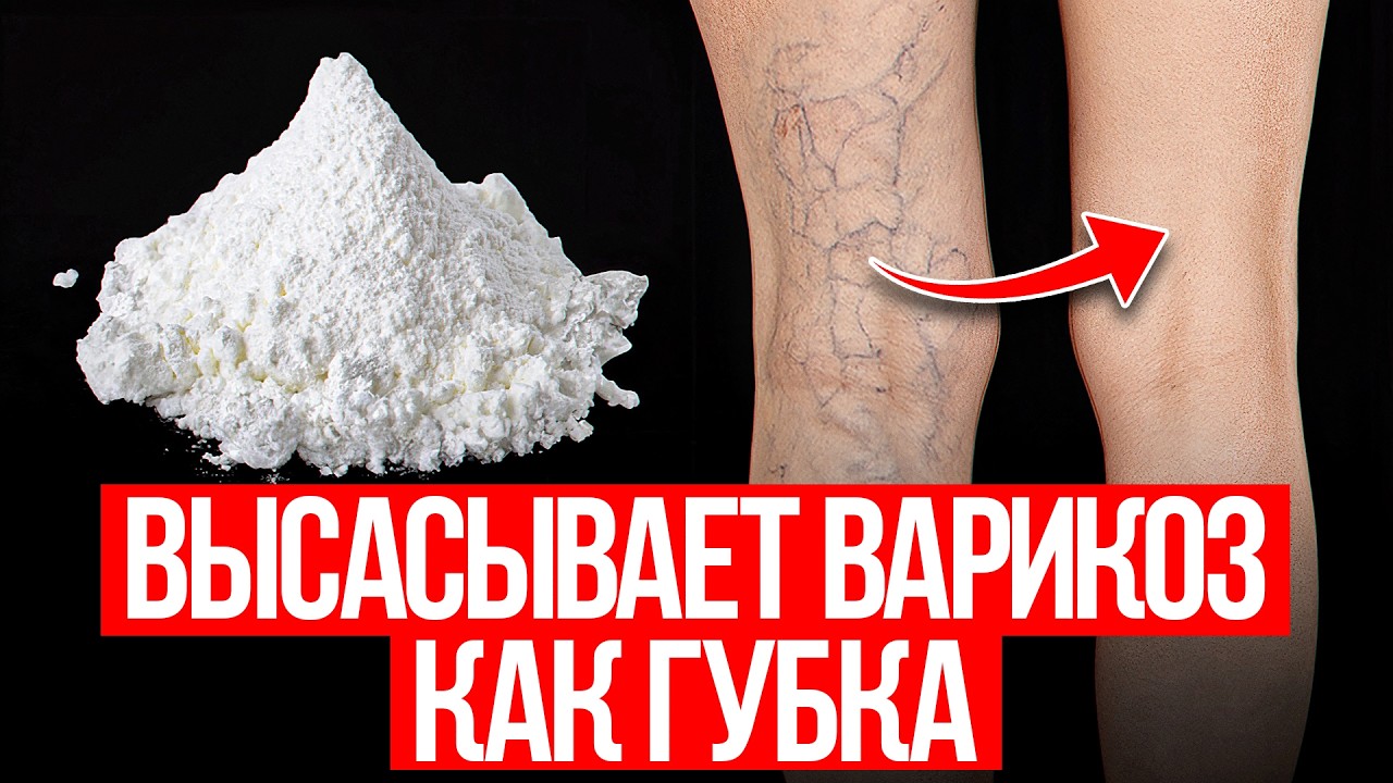 Оказывается, варикоз реально лечится! Простые средства есть у каждого дома!