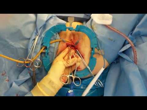 Uterine Prolapse Surgery:  Robotic Vaginal Sacral Colpopexy