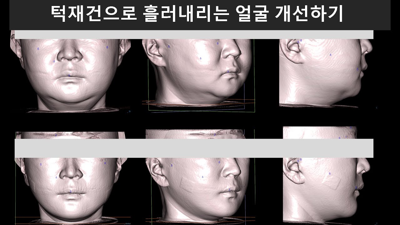 Можно ли улучшить состояние обвисшего лица с помощью реконструкции нижней челюсти?