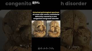 Historical pathological specimen of a man with severe craniofacial deformity #healthchannel #askdoc