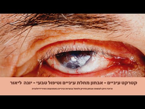 קטרקט עיניים - אבחון מחלת עיניים וטיפול טבעי - יונה  ליאור