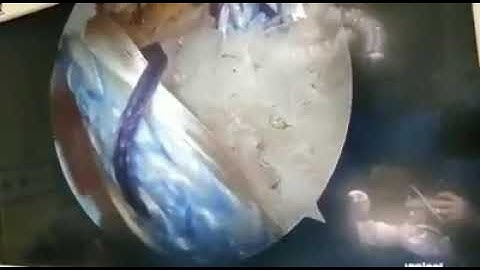 Arthroscopic Coracoclavicular Ligament Reconstruction by Dr Ayyappan V Nair, Shoulder Surgeon
