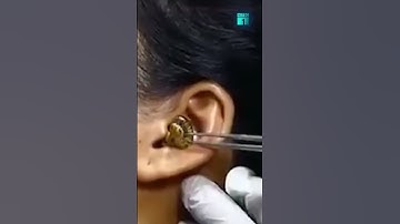 Xôn xao hình ảnh rắn chui vào tai người không chịu ra | VTC1