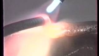 Depositing Process On Tooth Point