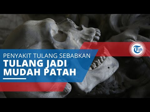 Osteogenesis Imperfecta, Penyakit Tulang Sebabkan Keadaan Tulang Sangat Rapuh dan Mudah Patah