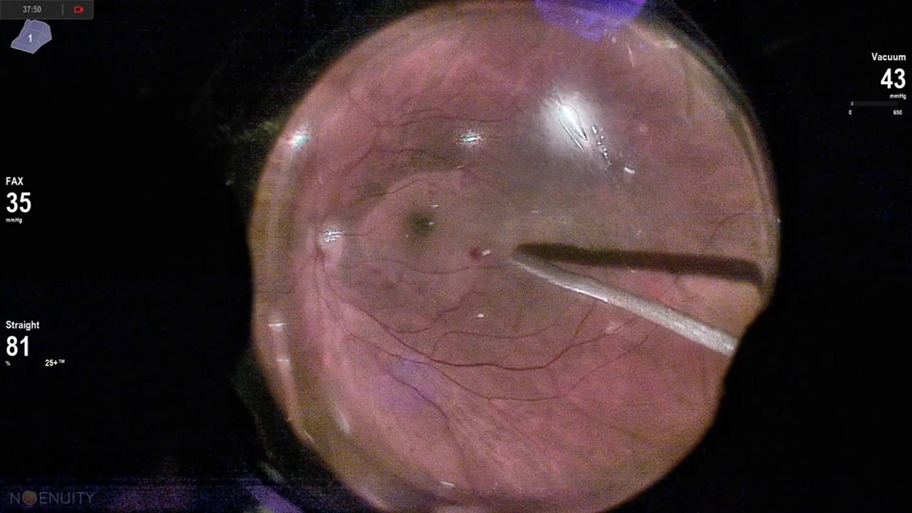 FTMH with ILM envelope Ophthalmic surgery live 18+ Lukan Mishev