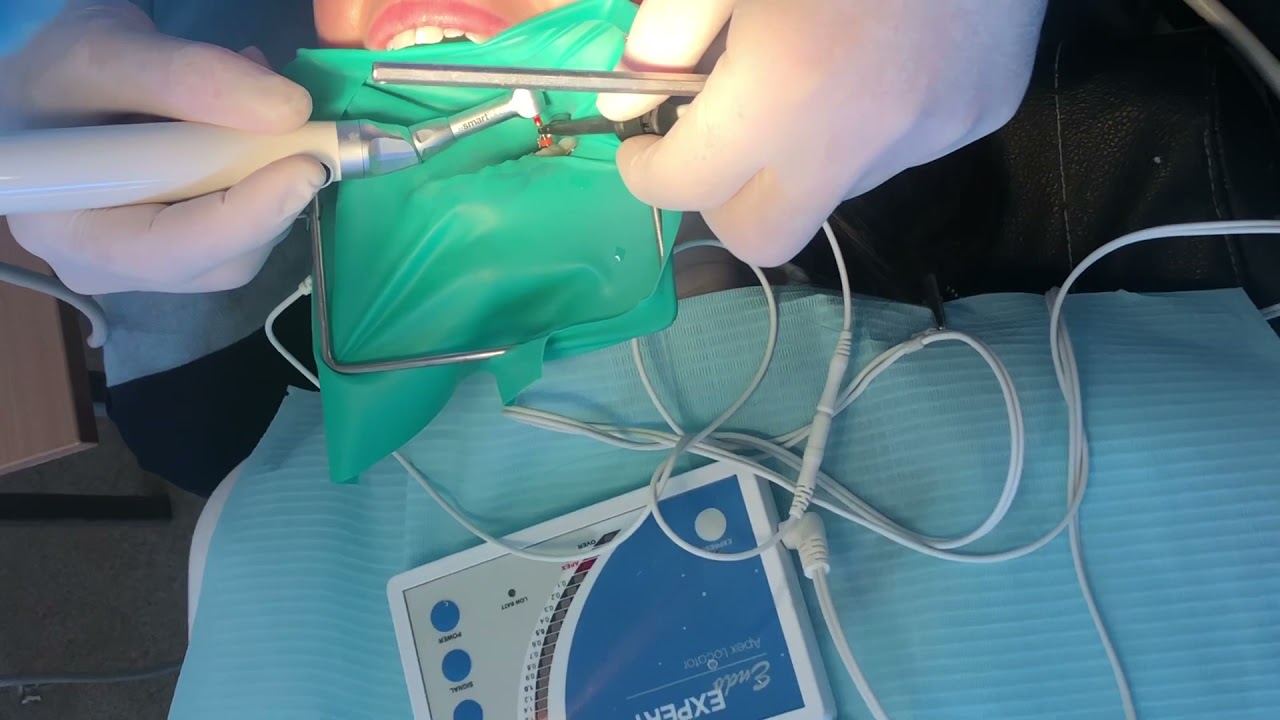 Протокол лечения корневых каналов