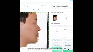 WEBCEPH Tutorial Shorts: Visual Treatment Simulation screenshot 4