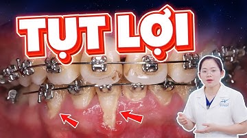 Tụt Lợi Khi Niềng Răng: 4 Dấu Hiệu Cảnh Báo Niềng Răng Bị Tụt Lợi - Bác sĩ Chỉ Cách Chữa Nhanh Nhất!