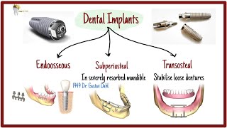 3 Types of Dental Implants and Surface treatments explained!