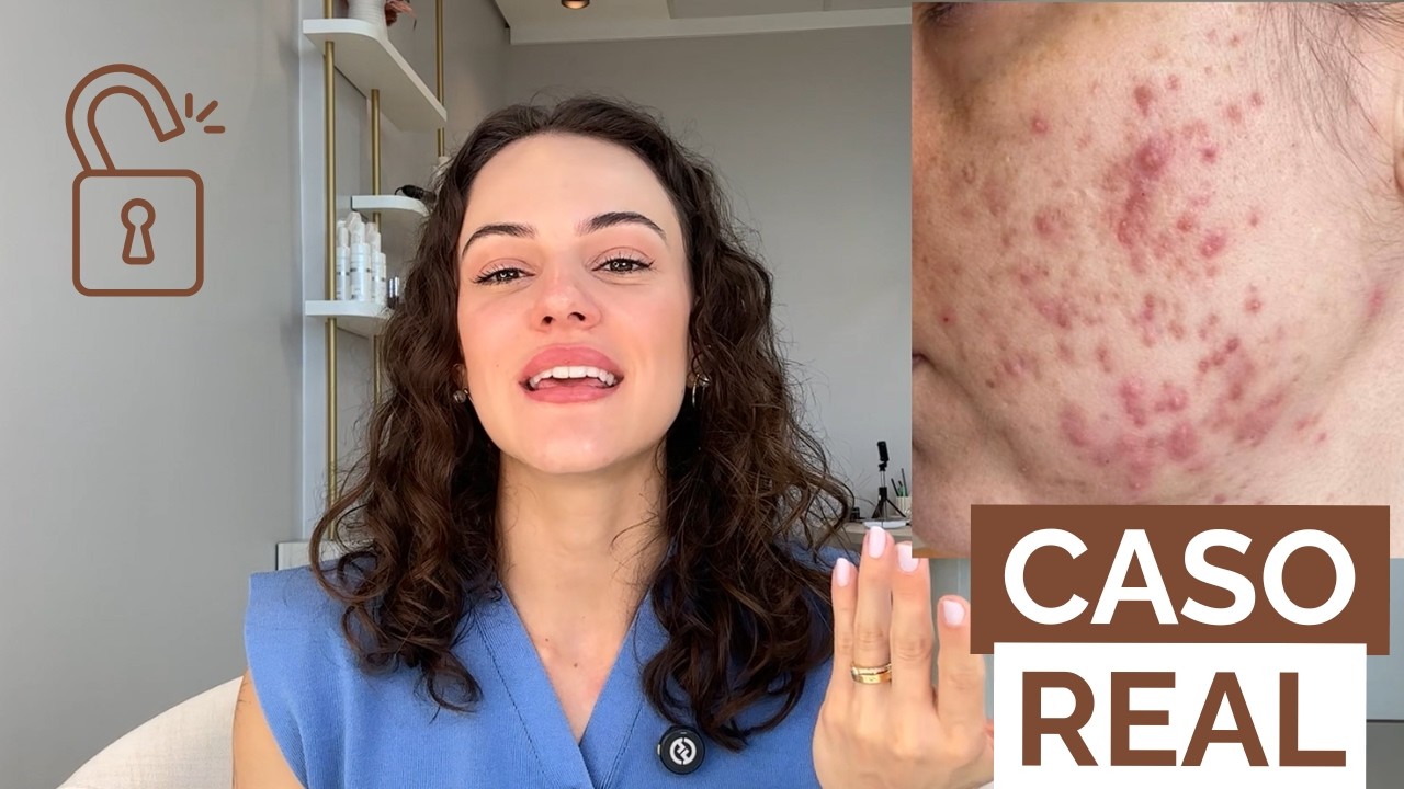 Por que essa acne adulta não melhorava? (CASO REAL EXPLICADO)