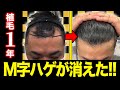 【祝1年経過】自毛植毛で人生変わるくらい変化しました!【M字ハゲ】