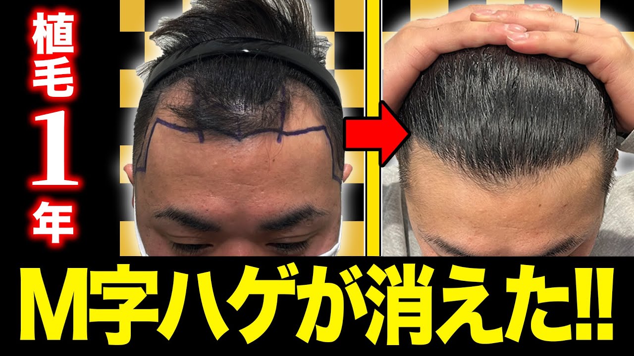若年性M字ハゲ 総額公開】M字ハゲだけを確実に改善するAGA治療！ - 湘南AGAクリニック