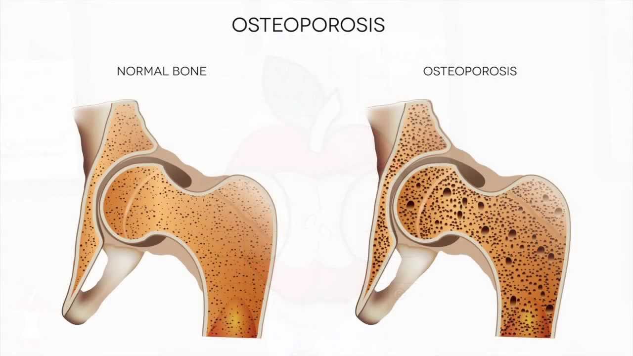What is Osteoporosis with Dr. Ron Short 