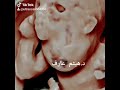 Fetal Cervical Teratoma Ultrasound By Dr Haissam Aref DMS MSc MD Ultrasound Fetal Cervical Teratoma Ultrasound By Dr Haissam Aref DMS MSc MD Ultrasound