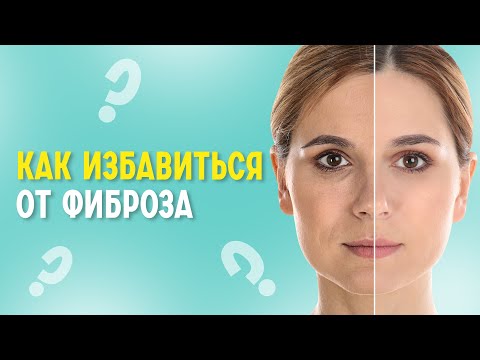 Бейне: Фиброзды колонопатия дегеніміз не?