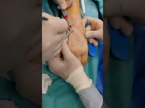 Βίντεο: Υπάρχει χειρουργική επέμβαση στο μέτωπο;