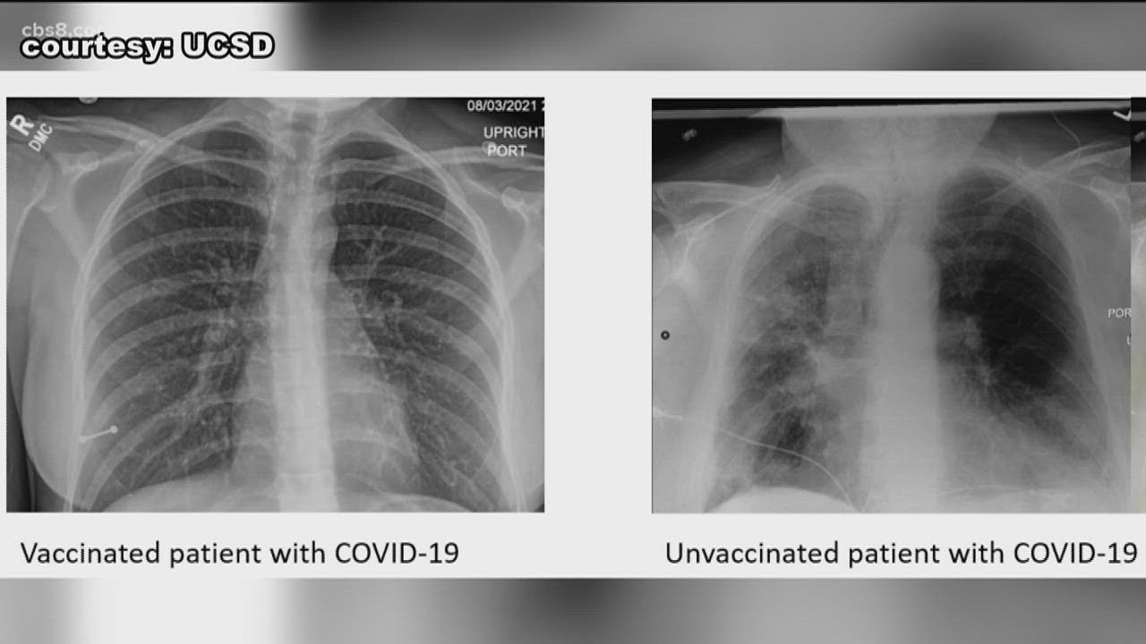 Here's how lung X-rays look between vaccinated and unvaccinated ...